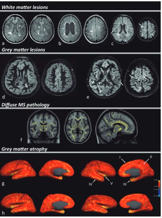Figure 1. MRI metrics associated to brain damage and MS-related cognitive impairment. Examples of the multiple facets of MS pathology, white matter  [A, B and C), grey matter lesions [D and E], diffuse MS pathology [F] and cortical grey matter atrophy [G a
