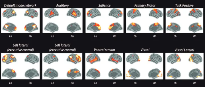 Figure 3. Reconstruction of WM tracts using DTI tractography. The cingulum is one of the most important components of the limbic system, and it has  been associated with attention, temporal orientation, information processing and executive functions