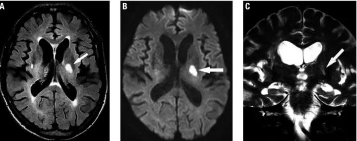 Figure 1. Recent small subcortical infarct. A 75-year-old man with sudden onset of left hemiparesis