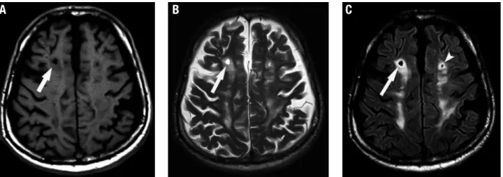 Figure 2. Lacune of presumed vascular origin. A 66-year-old patient with vascular dementia