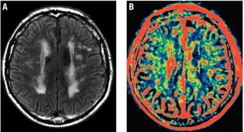 Figure 7. Cortical microinfarct. A 74-year-old  man with a history of hypertension and  diabe-tes mellitus
