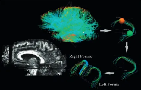 Figure 1. Depiction of virtual delineation by  deterministic tractography (Trackvis protocol for  tract delineation)