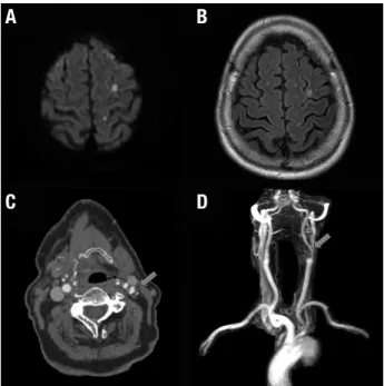 Figure 1. Diffusion-weighted imaging (A) and T2-FLAIR (B) MRI showing  multiple small hyperintense foci in the middle frontal and post central  gyri