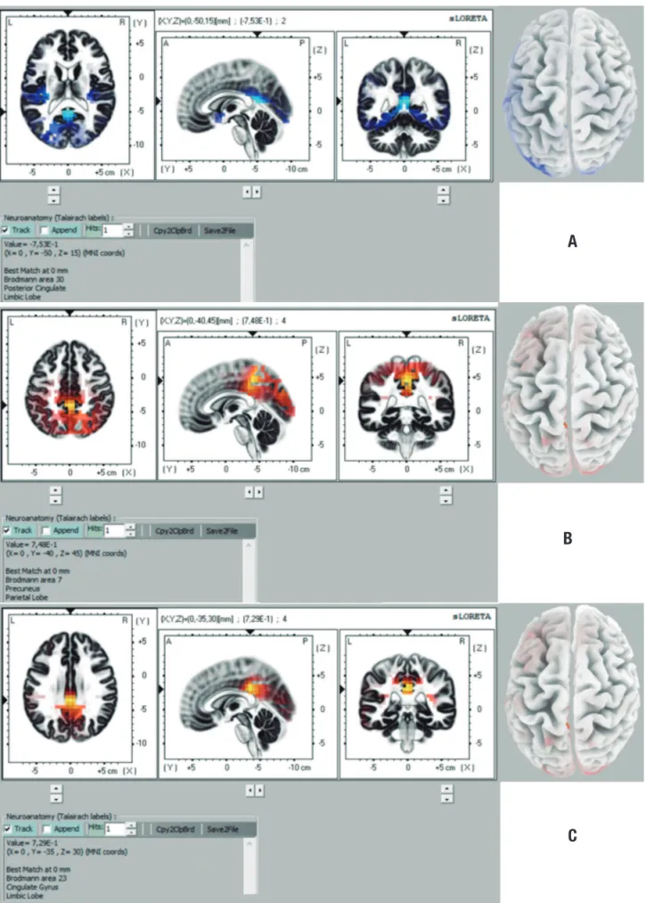 Figure 1. Representation of brain areas with statistically significant differences in comparison CTL × AD for theta band on 32-channel analysis (CTL&lt;AD)  [A], for alpha 2 band on 32-channel analysis (CTL&gt;AD) [B] and for alpha 2 band on 64-channel ana