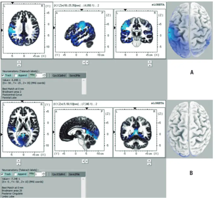 Figure 2. Representation of brain areas with statistically significant differences on comparison CTL × DAI for theta band on 32-channel analysis  (CTL&lt;DAI) [A], and for theta band on 64-channel analysis (CTL&lt;DAI).