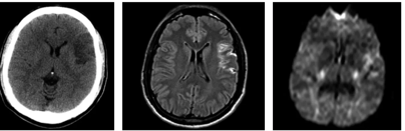 Figure 1. Cranial Computed Tomography in  axial section showing hypodense area in the  left inferior frontal gyrus topography.