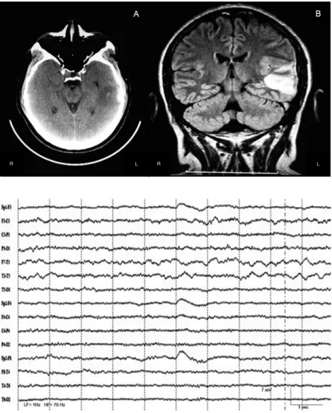 Figure 1. [A] Brain CT from admission showing  small hyperdense spots within hypodense area  in left temporal lobe