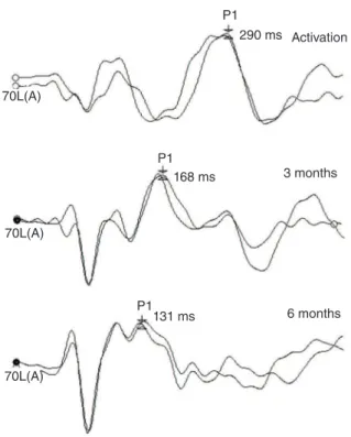 Figure 1. Data obtained from investigating cortical auditory evoked  potentials at the moment of activation of the cochlear implant, at three  months and at six months after the procedure in a female patient who  was 2 years and 6 months old at the time of