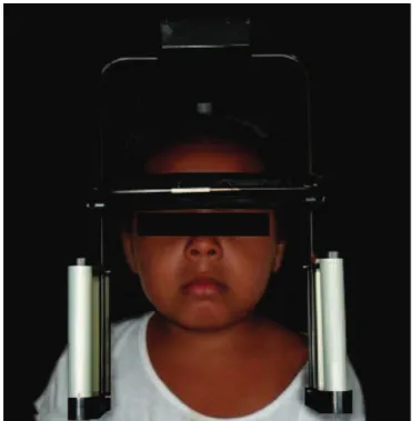 Figure 1. Electrognathography positioned on the child’s head