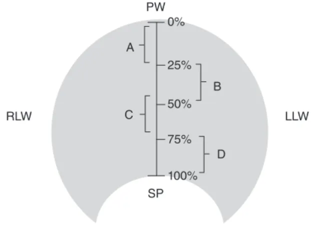 Figure 2. Reference scheme of the displacement of the posterior  pharyngeal wall in four quadrants