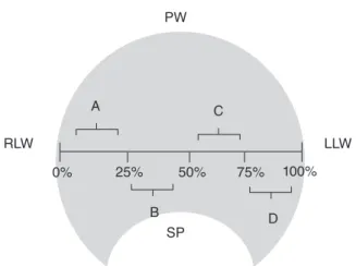 Figure 3. Reference scheme of the displacement of the lateral  pharyngeal wall in four quadrants