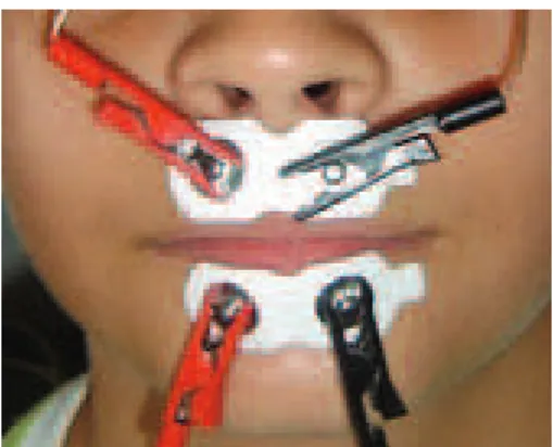 Figure 1. Placement of electrodes on the upper and lower orbicularis  oris muscle