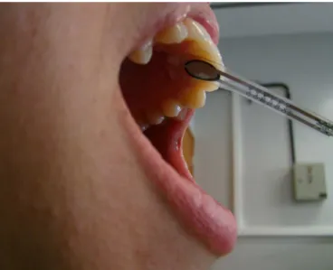Figure 1. Resistive sensor fixed to the palatal surface of the maxillary  right central incisor