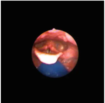 Figure 1. Posterior oral spillage in the A individual