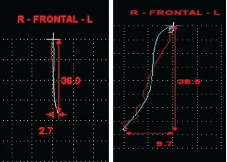 Figure 3. Charts of the opening path of the jaw