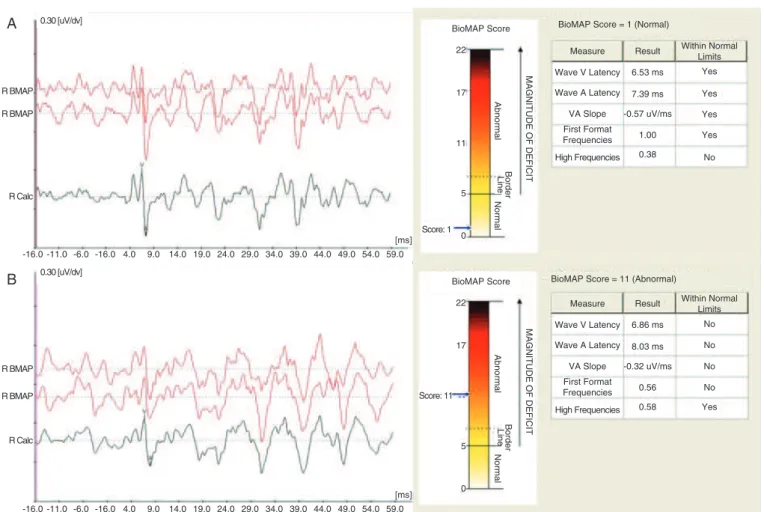 Figure 1. Example of ABR waveforms