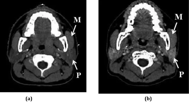 Figura 13: (a): Corte Axial de uma TC de um paciente com carcinoma nasofaríngeo antes da  radioterapia,  mostrando  a  densidade  da  glândula  parótida  sendo  a  mesma  do  que  o  músculo  masséter  adjacente