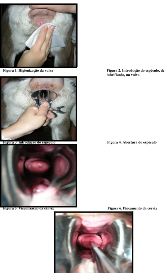 Figura 1. Higienização da vulva Figura 2. Introdução do espéculo, devidamente lubrificado, na vulva
