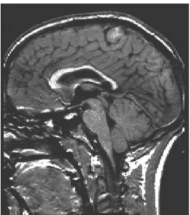 Figura  1-Imagem  de  um  sujeito  grande  pré-termo,  mostrando  a  evidência  do  estreitamento  do  corpo  caloso  (Adaptado  Rushe, Temple, Rifkin, et al, 2004 ; F113) 