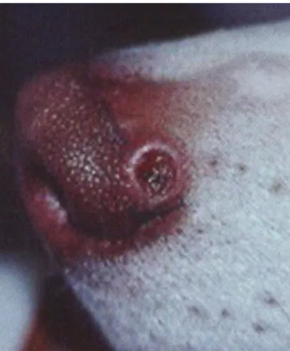 Figura 8 - Lesão de cancro de inoculação na ponta nasal (adaptado de Ocanã et al., 2007) 