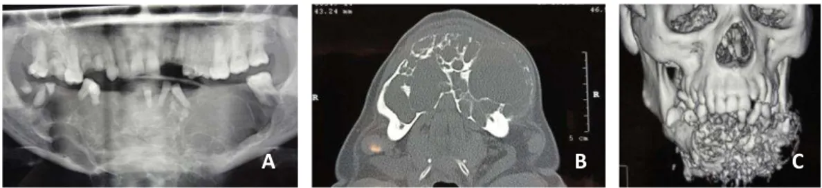 FIGURA 2: A: radiografia panorâmica; B: tomografia computadorizada corte axial; C: tomografia computadorizada  reconstrução 3D; 