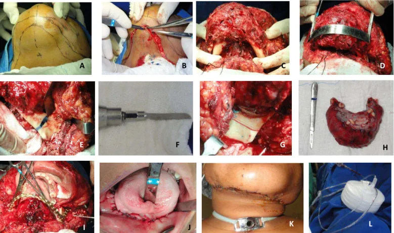 Figura 3 : Ato cirúrgico. A: Marcação do acesso; B: Acesso Risdon estendido bilateral; C: Vista da lesão e parte de osso mandibular sadio; D: Vista da lesão; E:  Marcação da osteotomia do lado esquerdo da mandíbula com 1cm de margem de segurança; F: Serra 