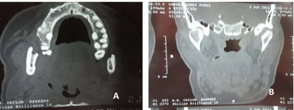 FIGURA 10:  Tomografia computadorizada de 14 meses de pós operatório.A: Corte  axial; B: Corte coronal