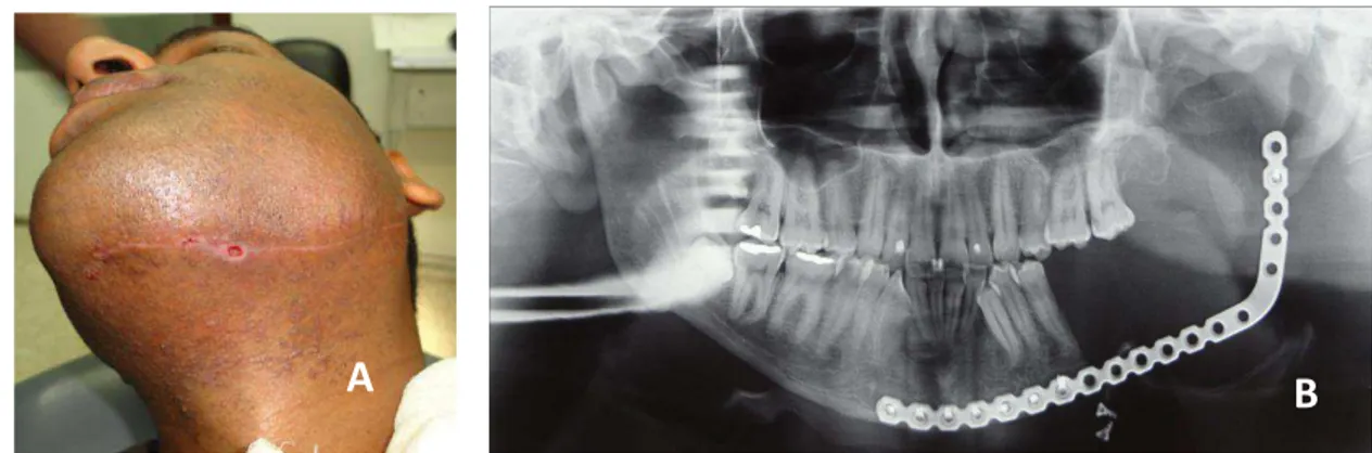 FIGURA 17 : reintervenção cirúrgica; A: vista clínica pré-operatório; B: acesso à placa de reconstrução para apertamento dos  parafusos; C: sutura extra-oral
