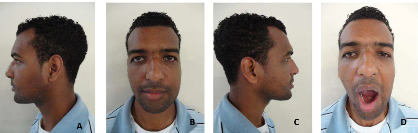 FIGURA 18 :dois meses após a reintervenção cirúrgica;  A: vista perfil lado direito; B: vista frontal; C: vista perfil lado esquerdo;  D: Vista frontal- abertura bucal