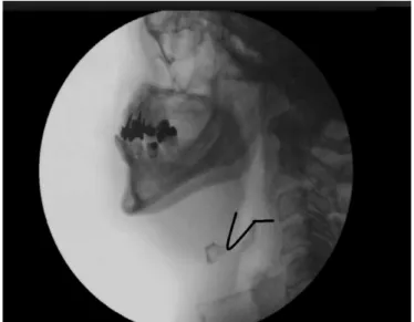 Figure 1. Consultation with databases for literature review as to onset  location of the pharyngeal phase of swallowing, according to search  with the keywords fluoroscopy (fluoroscopia), swallowing (deglutition)  and pharynx (faringe) (2005-2015)