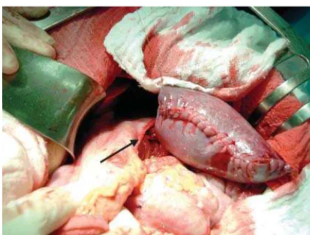 Figure 1 - Surgical aspect of subtotal splenectomy performed in a patient with portal hypertension