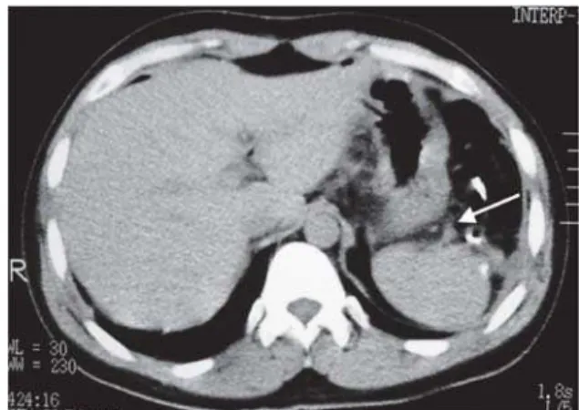 Figure 2 - Tomographic image of splenic remnant during the late postoperative periods following subtotal splenectomy for splenic ischemia.