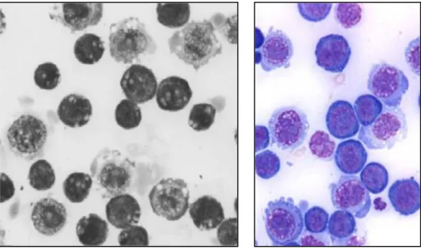 Figura 10: Esfregaços de células do líquido ascítico do tumor  de  Ehrlich  em  camundongos  fêmeas:        