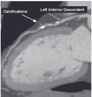 Figure 1 - Ultra fast multislice computer tomography of coronary arteries.