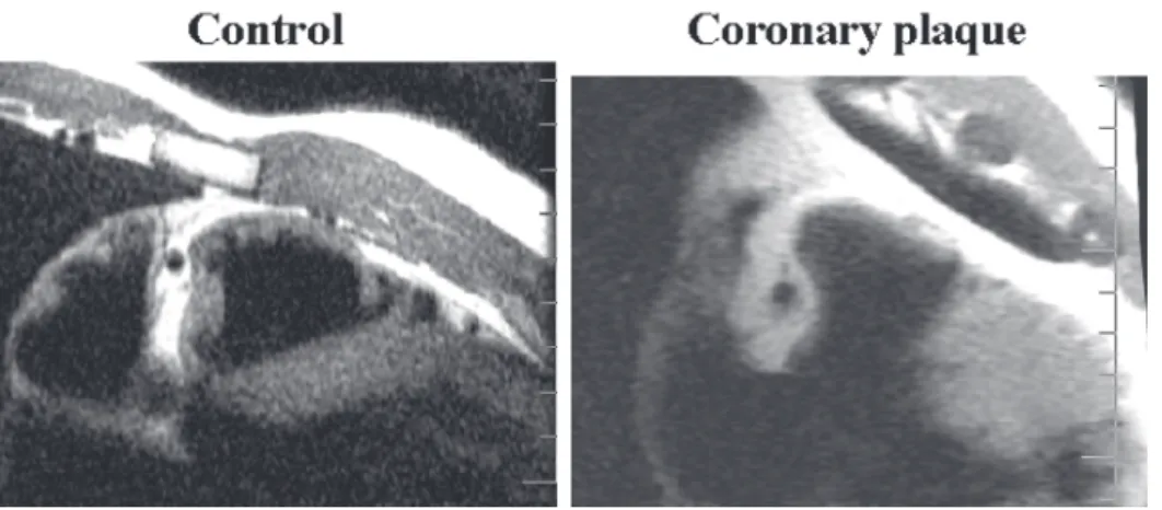 Figure 3a - Magnetic resonance of coronary arteries. Positive remodeling of coronary arteries indicated by increased wall thickness, wall area, and total vessel area with preservation of luminal area 104