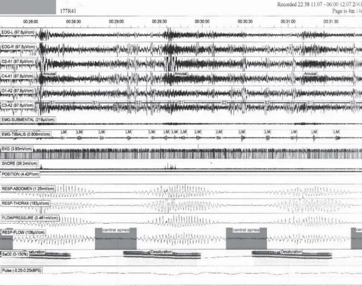 Figure 1 - Polysomnographic recordings of a congestive heart failure presenting Cheyne-Stokes respiration during sleep