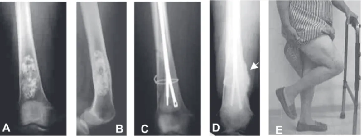 Figure 1 - Patient with a grade I chondrosarcoma who underwent an intralesional resection