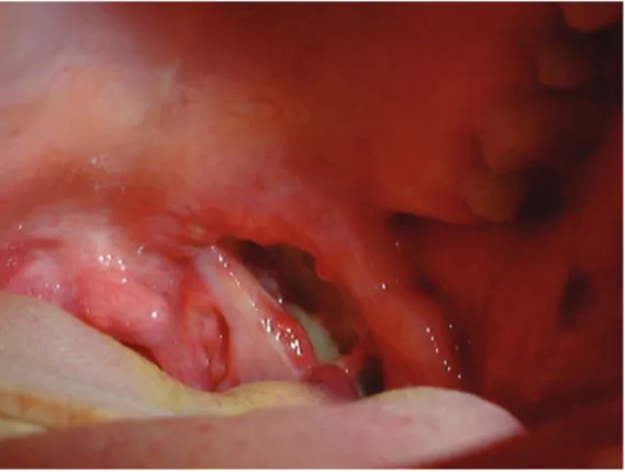 Figure 1 - Bacterial tonsillitis and abscess.
