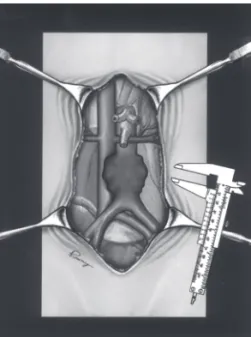 Figure 2 - The technique of aneurysm using a measurement caliper.