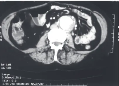 Figure 5 - Helical computerized tomography imaging: 3-D reconstruction of the abdominal aorta.