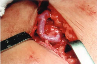 Figure 2 - Brachiocephalic arteriovenous fistula. Note the termino- termino-lateral anastomosis of the vein to the artery.