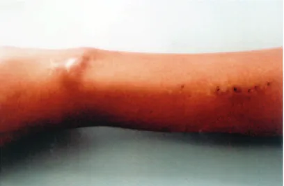 Figure 3 - Patent radiocephalic arteriovenous fistula in a girl weighing 15 kg.