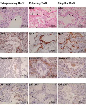 Figure 1 shows the histological features of HM in pDAD, expDAD, and iDAD.