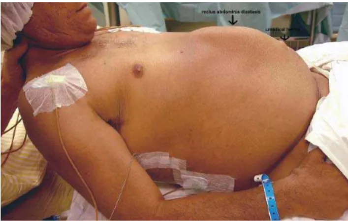 Figure 2 - Rectus abdominis diastasis and umbilical hernia in a ADPKD patient