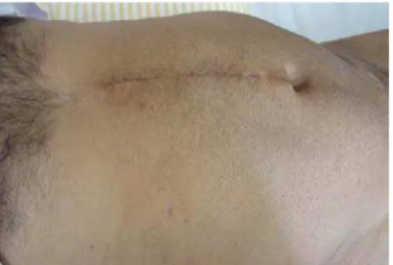 Figure 3 - U-shape stitches allowing the overlapping of the borders of the incision