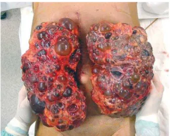Figure 6 - The incision of much smaller size than the kidney, with no emptying of the cyst and no morcellation of the kidney required