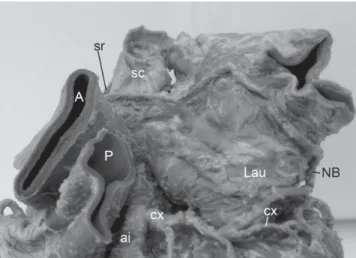 Figure 4 - The sinuatrial nodal branch (NB) is type L3a and describes a route in “S” form