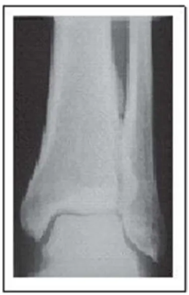 Figure 2 - Anteroposterior view of radiographs showing fingers and toes with mushrooming of the tufts (2A, 2B)