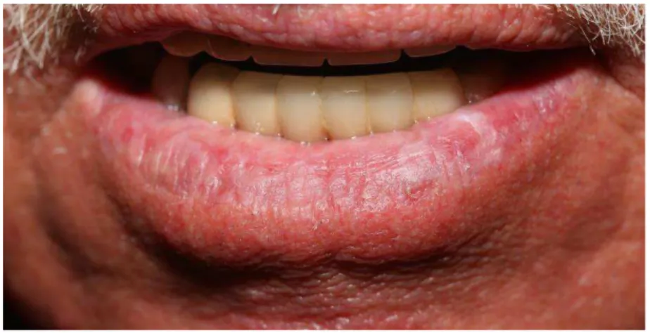 Figura 1: Aspecto clínico da QA em lábio inferior: lesões leucoplásicas distribuídas  por  todo  o  lábio  inferior,  com  perda  do  limite  do  vermelhão  do  lábio  e  algumas  áreas  eritoplasicas