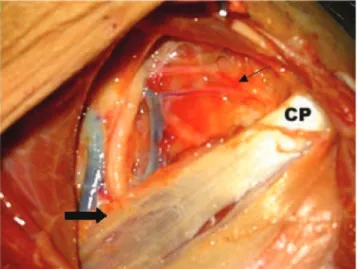 Figure 4 - Left shoulder: the musculocutaneous nerve (wide arrow) laterally to the median nerve, and origin of the acromial artery (narrow arrow), a branch of the deltoid artery